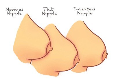 Inverted Nipple Breastfeeding Tips